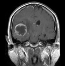 Hersenscan van persoon met tumor.