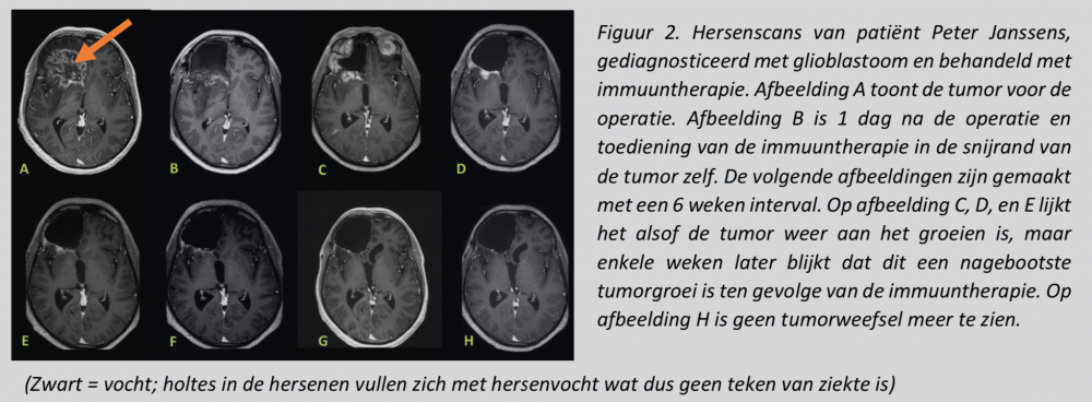 Figuur 2. Hersenscans van patiënt Peter Janssens, gediagnosticeerd met glioblastoom en behandeld met immuuntherapie.