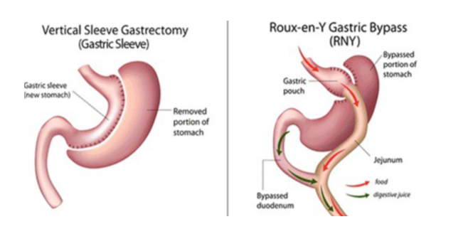 Sleeve Gastrectomy en Roux-en-Y Gastric Bypass (Pories, sd)