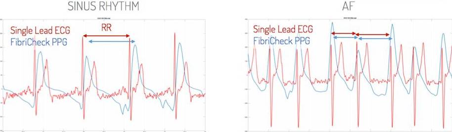 Een voorbeeld van beat-to-beat-analyse. Een vergelijking tussen de FibriCheck-app en het 1-afleiding-ECG. Links: een normaal hartritme. Rechts: voorkamerfibrillatie.