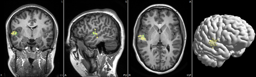 Cluster van interictale epileptiforme activiteit (geel) in een patiënt met refractaire epilepsie