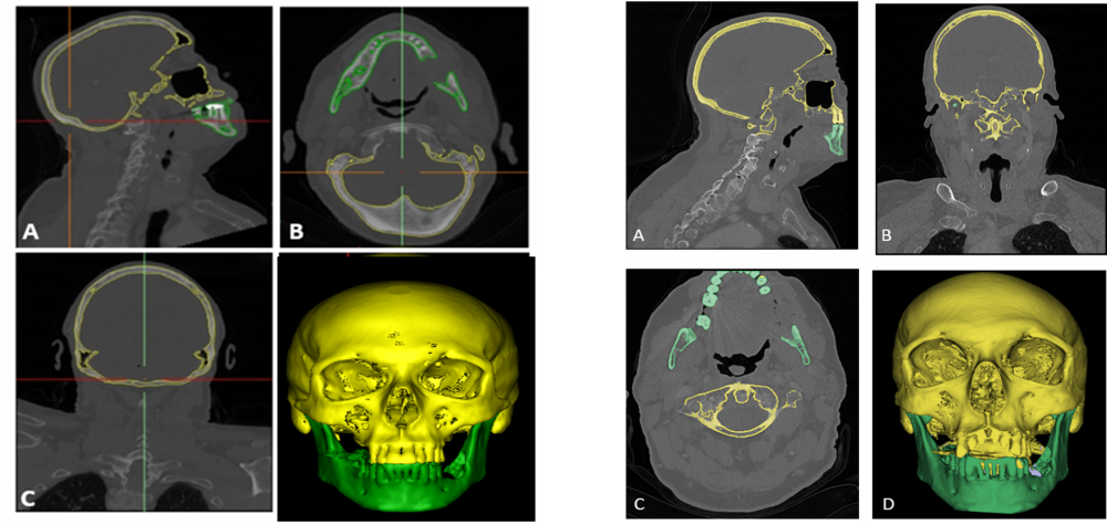 2  Vergelijking segmentatie links betalende software Materialise; rechts gratis software 3D-slicer A) Sagitaal zicht CT-scan. B) Axiaal zicht CT-scan. C) Coronaal zicht CT-scan. D) 3D projectie vanuit CT 