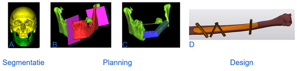 workflow virtuele chirurgische planning A: segmentatie; B: osteotomie plaatsen van zaagsnede; C: reconstructie met kuitbeen; D: design guides
