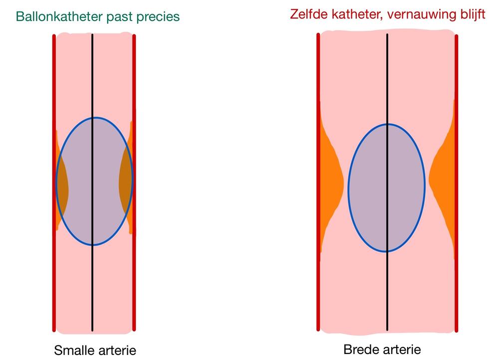 Eén ballonkatheter, twee verschillende diameters, dit illustreert dat dezelfde maat niet overal past niet.