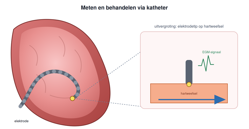 Illustratie van een elektrode die via een bloedvat in het hart wordt gebracht om elektrische signalen te meten.